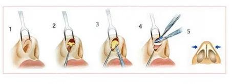 微調(diào)鼻子需要多少錢，全面解析費用因素與注意事項，微調(diào)鼻子費用全解析，費用因素與注意事項，需要多少錢？