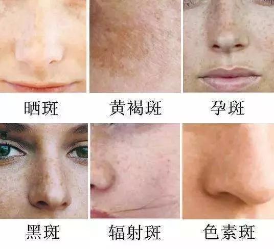 如何有效去除臉上斑點(diǎn)——全方位指南，全方位指南，如何有效去除臉上斑點(diǎn)