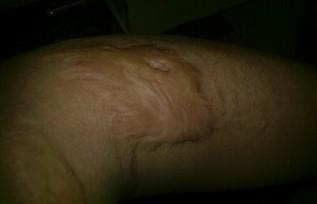 當(dāng)兵不合格的疤痕圖，解析與應(yīng)對建議，當(dāng)兵不合格疤痕圖詳解及應(yīng)對建議