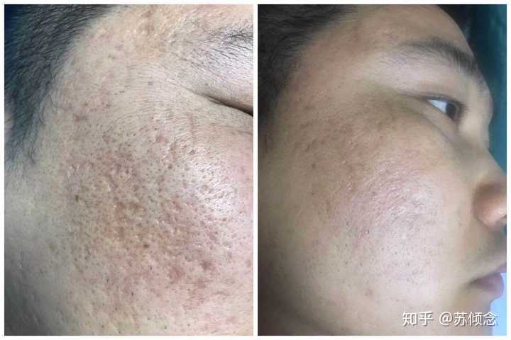 如何有效去除臉上的痘坑痘??？全面解析你的肌膚問(wèn)題，全面解析，如何有效去除臉部痘坑痘印，重塑肌膚光彩