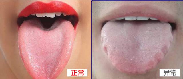 寒濕與濕熱舌頭圖片，中醫(yī)舌診解析，中醫(yī)舌診解析，寒濕與濕熱舌頭圖片對比及解析