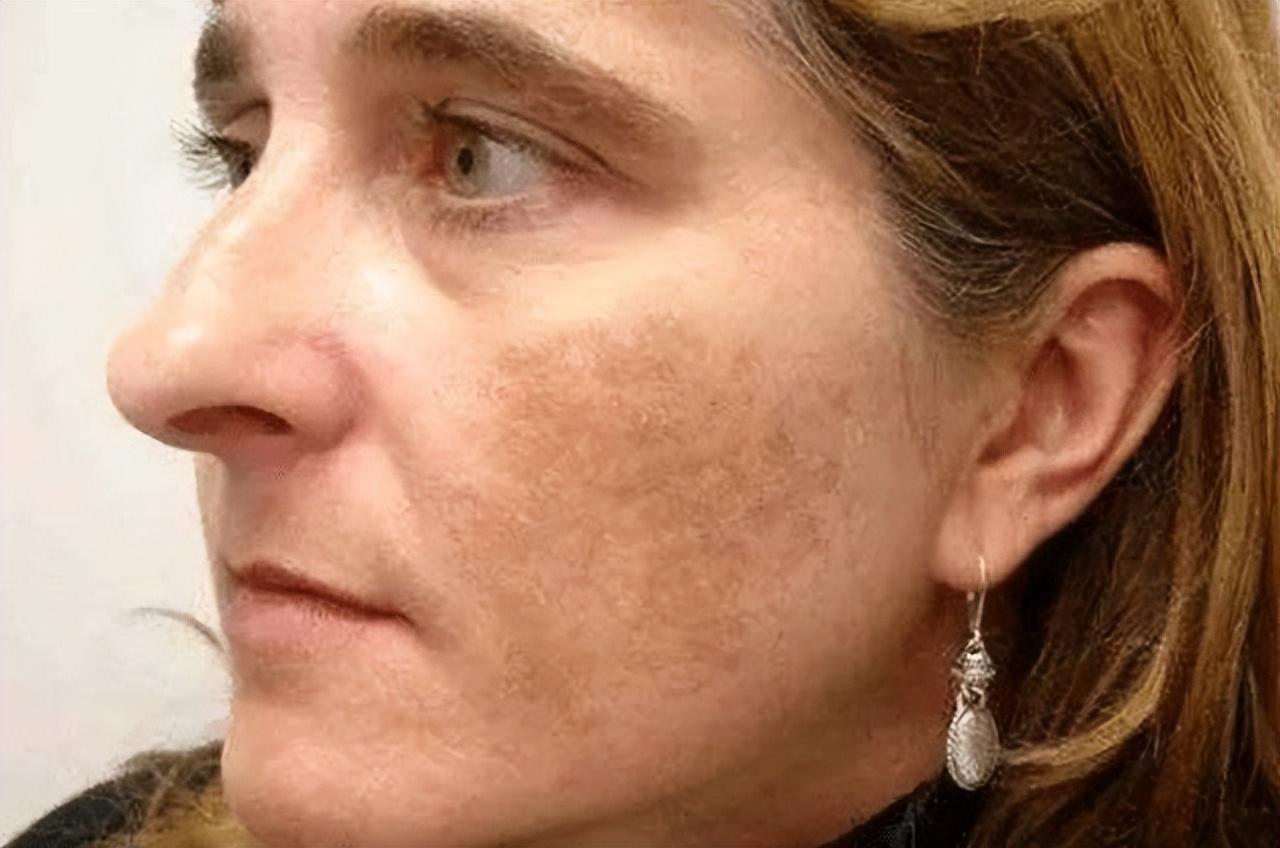 如何有效去除老年斑——全方位指南，全方位指南，如何有效去除老年斑