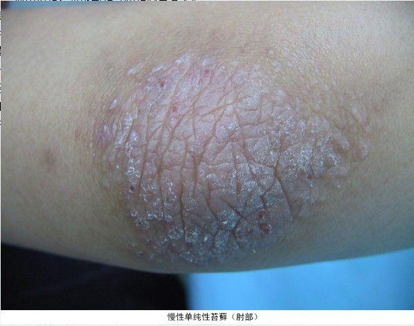 牛皮膚癬怎么根治，全面解析與有效治療策略，全面解析牛皮膚癬的根治方法與有效治療策略