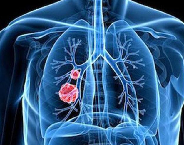 肺部感染恢復(fù)時間解析，多久能夠康復(fù)？，肺部感染恢復(fù)時間解析，多久可康復(fù)？