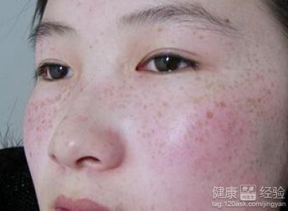 怎樣去除黃褐斑最快最有效，全面解析黃褐斑的成因與有效治療方法，全面解析黃褐斑成因及快速有效的去除方法