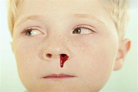 兒童白血病流鼻血的特點及其重要性，兒童白血病流鼻血特征與重要性解析
