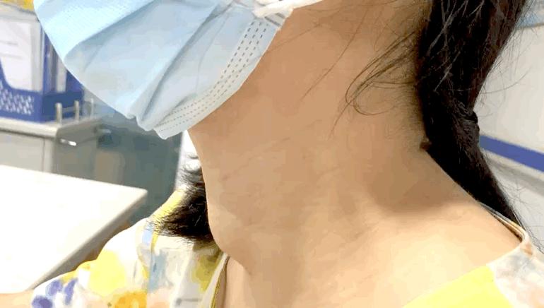 甲狀腺結節(jié)是被氣的嗎？深入了解甲狀腺結節(jié)的成因與防治，甲狀腺結節(jié)成因與防治，情緒因素與疾病關系探討