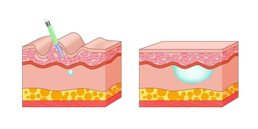 法令紋去除最安全永久的方法，全面解析與實(shí)用建議，全面解析法令紋永久安全去除法，實(shí)用建議與最佳實(shí)踐