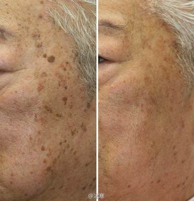 如何有效去除老年斑——全面解析，全面解析，有效去除老年斑的方法