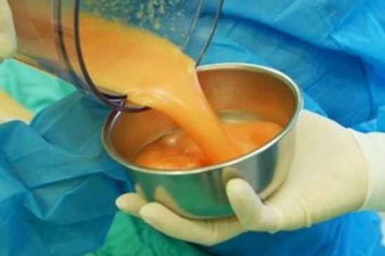 雙下巴抽脂手術費用詳解，價格因素與預算參考，雙下巴抽脂手術費用解析，預算參考與價格因素探討