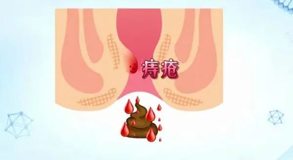 大便出血，痔瘡還是肛裂？一篇文章帶你了解，大便出血，痔瘡還是肛裂？一篇文章全面解析