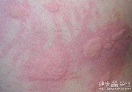 風疹是怎么引起的，風疹的成因解析