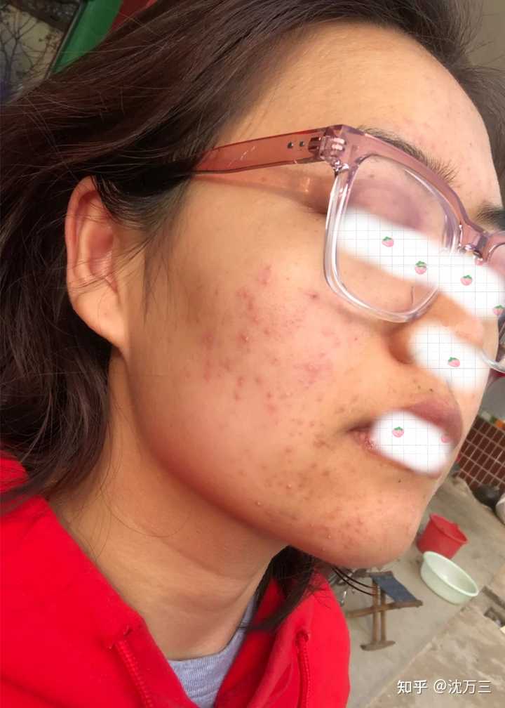 消除痤瘡留下的紅色痘印的有效方法，消除紅色痘印，痤瘡后的護(hù)膚秘訣