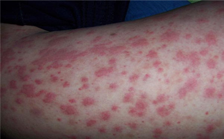 過(guò)敏性紫癜能自愈嗎？解析疾病真相與應(yīng)對(duì)之策，過(guò)敏性紫癜解析，能否自愈？真相與應(yīng)對(duì)策略探討