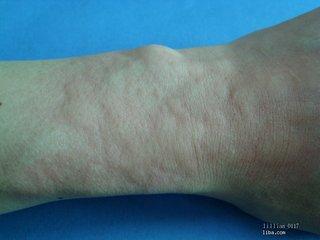 蕁麻疹患者的壽命，了解與應對蕁麻疹的關(guān)鍵知識，蕁麻疹患者的壽命影響及應對關(guān)鍵知識解析