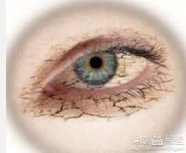 干眼癥怎樣能徹底治愈，全面理解與有效治療策略，全面理解與有效治療策略，干眼癥的根治之路