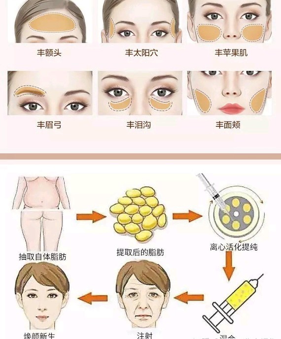 自體脂肪填充后最忌諱的幾個(gè)注意事項(xiàng)，自體脂肪填充后的關(guān)鍵注意事項(xiàng)與忌諱事項(xiàng)清單