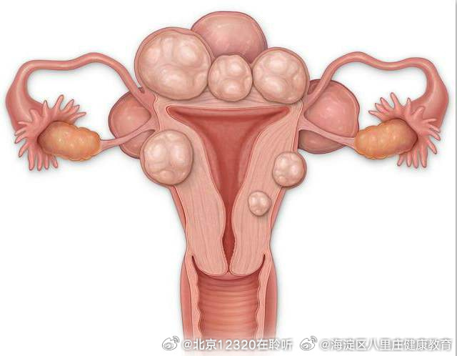 子宮肌瘤的最佳治療方法，全面解析與指導(dǎo)，子宮肌瘤的最佳治療方法詳解與指導(dǎo)手冊