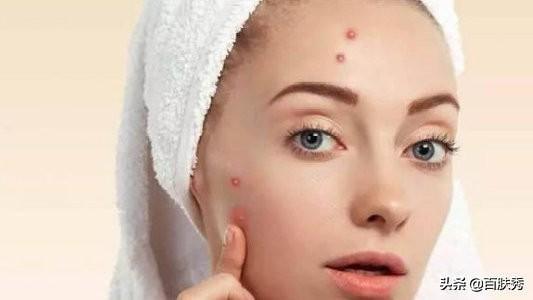 痤瘡是什么——深入了解痤瘡的成因、癥狀與治療方法，痤瘡解析，成因、癥狀及治療方法全面介紹