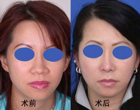 縮鼻翼手術(shù)風(fēng)險分析，風(fēng)險大嗎？，縮鼻翼手術(shù)風(fēng)險詳解，手術(shù)風(fēng)險是否大？